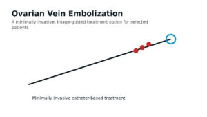 Illustration catheter-based ovarian vein embolization (conceptual).