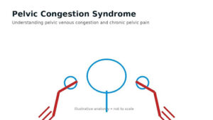 Pelvic Congestion Syndrome The Most Misdiagnosed Cause of Chronic Pelvic Pain in Women